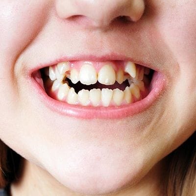 Misaligned Teeth- Causes and Treatment Options In Dubai