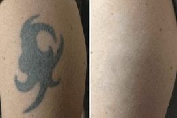 Picosure Tattoo Removal Treatment in Dubai Abu Dhabi
