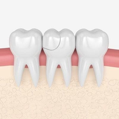 Veneers For Broken Teeth - Options to Fix Broken Tooth