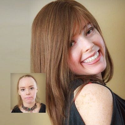 hair-restoration