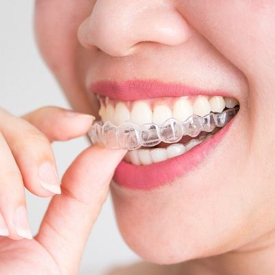 How Long Do You Have to Wear Invisalign®?