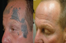 laser tattoo removal treatment in dubai