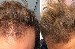 Stem Cell Hair Replacement