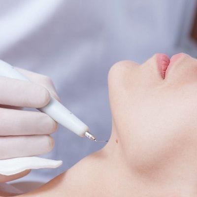 warts removal in Dubai