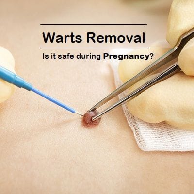 How to Get Rid of Warts During Pregnancy?