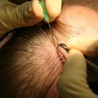 what is a hair graft