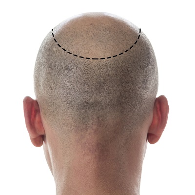 hair transplant cost affect