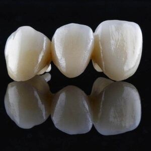 Dental Bridges Cost for Front Teeth in Dubai