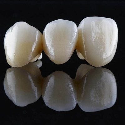 Dental Bridges Cost for Front Teeth - Dynamic Clinic