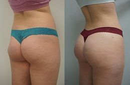 buttock augmentation Clinic in Dubai