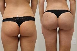 buttock augmentation in Dubai