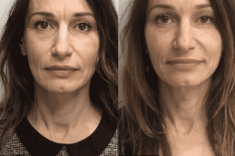 8-point-facelift-with-juvederm Clinic in Dubai