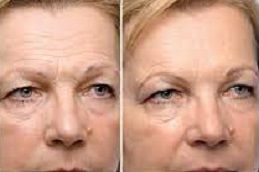 8-point-facelift-with-juvederm in dubai