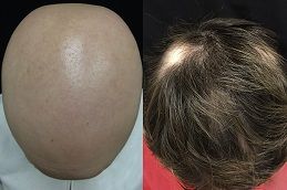 Best alopecia-areata-treatment in Abu Dhabi