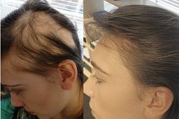 Best alopecia-areata-treatment in dubai