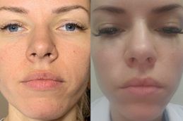 Best aquagold-fine-touch-facial in Abu Dhabi