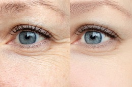 Best-botox-injection-for-wrinkles-in-dubai
