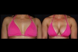 Best brava-breast-augmentation in Abu Dhabi