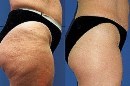 Best cellulite-removal-treatment in Abu Dhabi