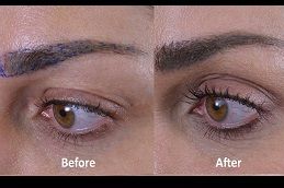 Best eyebrow-hair-transplant Clinic in Dubai