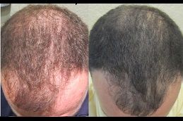 GFC Treatment For Hair In Dubai | Hair Regrowth Treatment