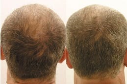 Best growth-factor-concentrate-for-hair-loss in Abu Dhabi