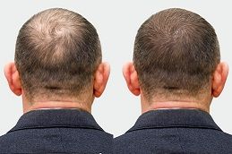 Best growth-factor-concentrate-for-hair-loss in dubai