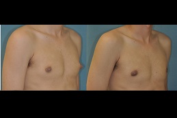 Best gynecomastia-male-breast-reduction in Abu Dhabi