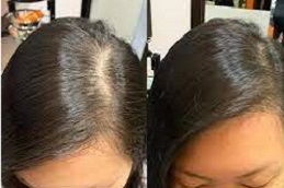 Best hair-fillers-for-baldness in dubai