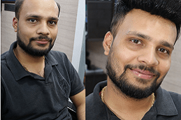 Best hair-transplant-in-ajman-fujairah in dubai