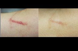 Best hypertrophic-scars-treatment in dubai