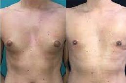 Best inverted-nipple-surgery in Abu Dhabi