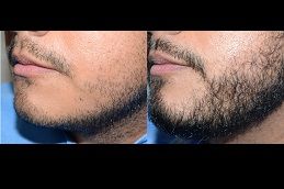 Best mustache-hair-transplant in dubai