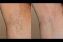 Best non-invasive-hair-removal in Abu Dhabi
