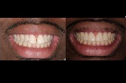 Best protruded-teeth Clinic in Dubai