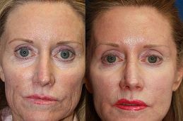 Best-radiesse-filler-injections-Clinic-in-Dubai