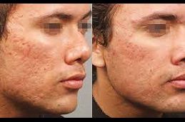 Best radio-frequency-for-acne-scars Clinic in Dubai