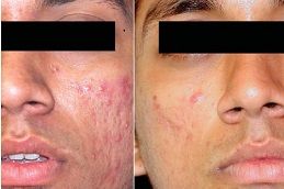 Best radio-frequency-for-acne-scars in Abu Dhabi