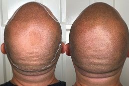 Best scalp-micropigmentation-smp in Abu Dhabi