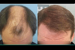 Best sideburn-hair-transplant in Abu Dhabi