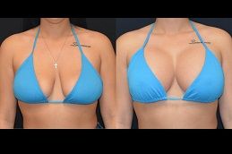 Best silicone-breast-implants in Abu Dhabi