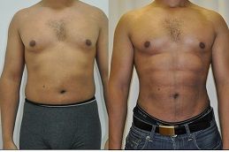 Best six-pack-abs-surgery in dubai