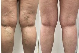Best spider-veins-removal Clinic in Dubai