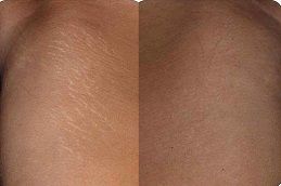Best stretch-marks-removal Clinic in Dubai