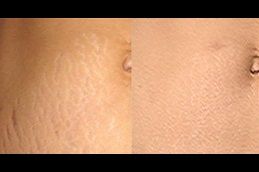 Best stretch-marks-removal in Abu Dhabi