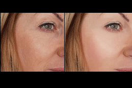 Best wrinkle-smoothing Clinic in Dubai