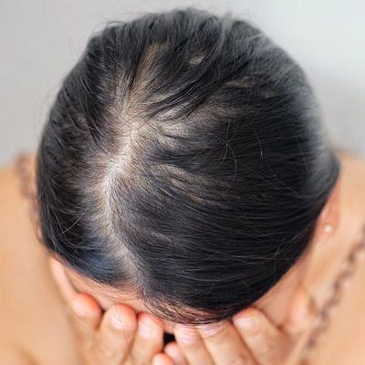 Hair Fall Treatments in Dubai, Abu Dhabi & Sharjah | Dynamic Clinic