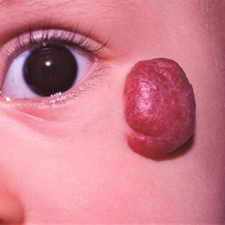 Strawberry Hemangioma Treatment for Baby in Dubai