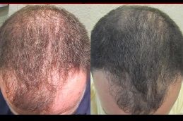 acell-prp-therapy-hair-loss Clinic in Dubai