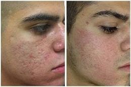 acne-scar-treatment in Abu Dhabi